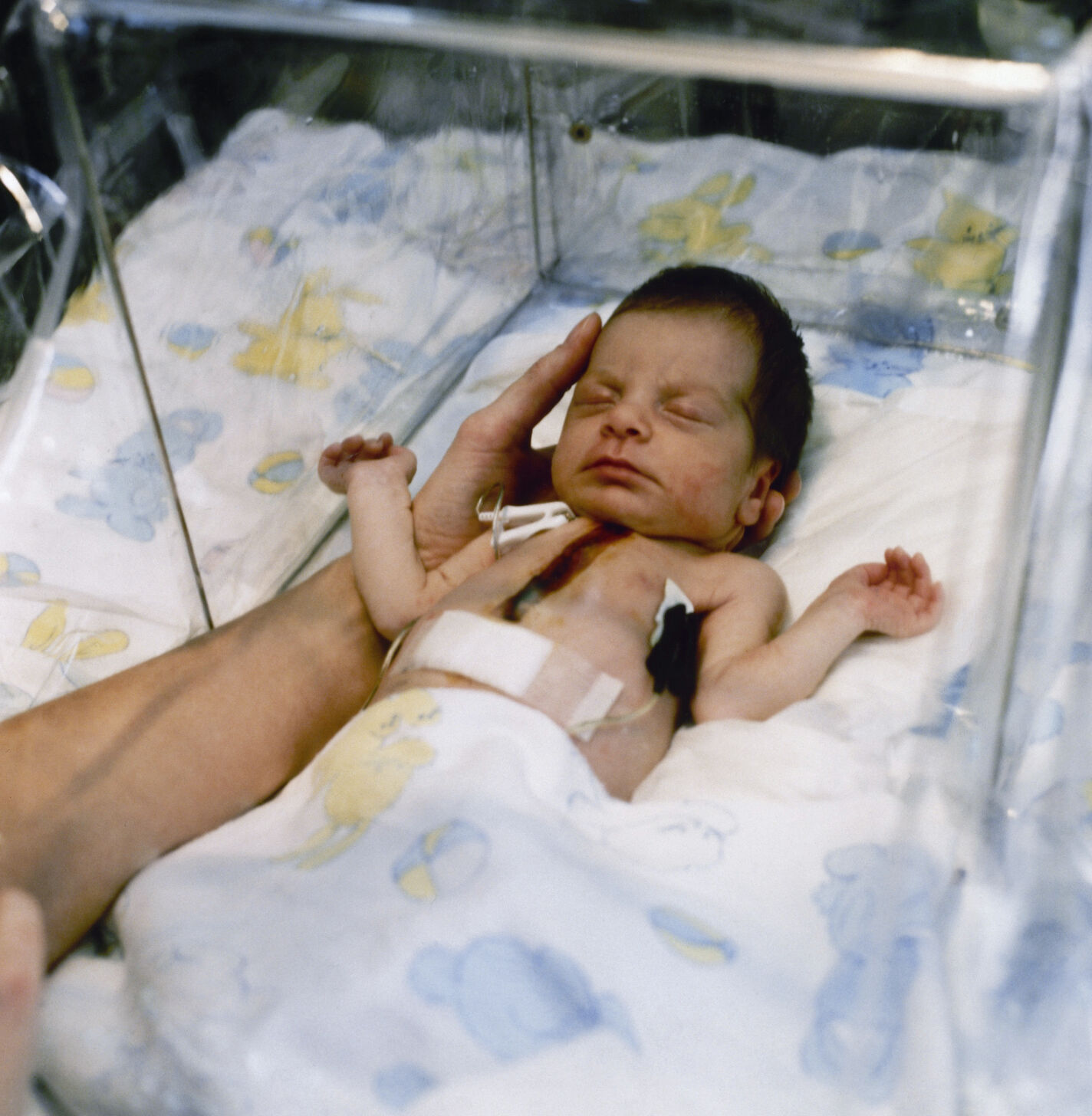 1984: "Baby Fae"